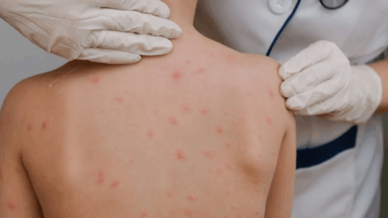 Salta confirmó dos casos de viruela del mono: las recomendaciones para Jujuy