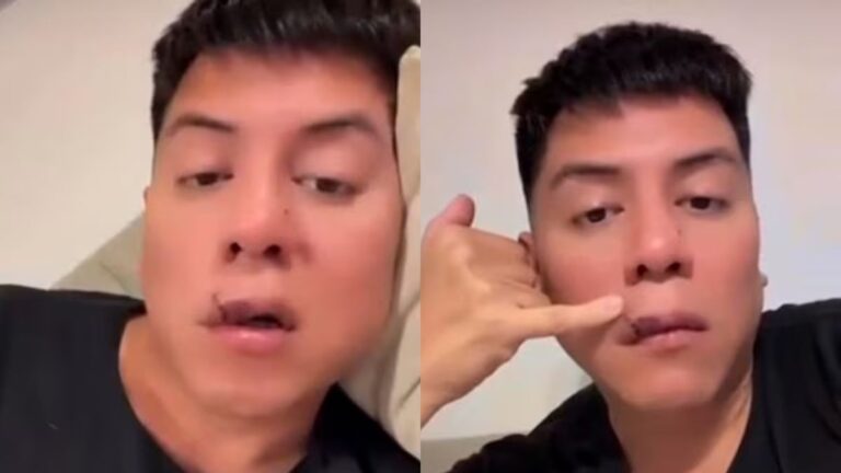 Mariano de la Canal fue mordido por un perro en la cara: así mostró cómo le quedó